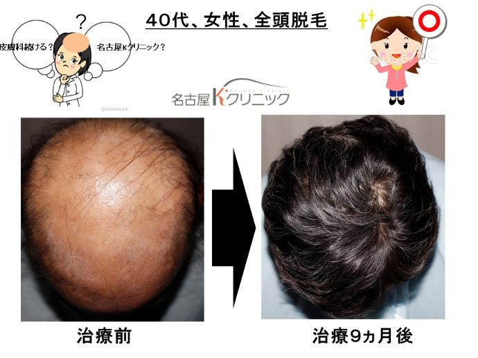 円形脱毛症　病院